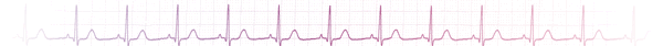 EKG
